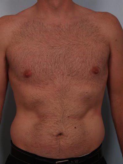 Male Breast/Areola Reduction Gallery - Patient 1311002 - Image 6