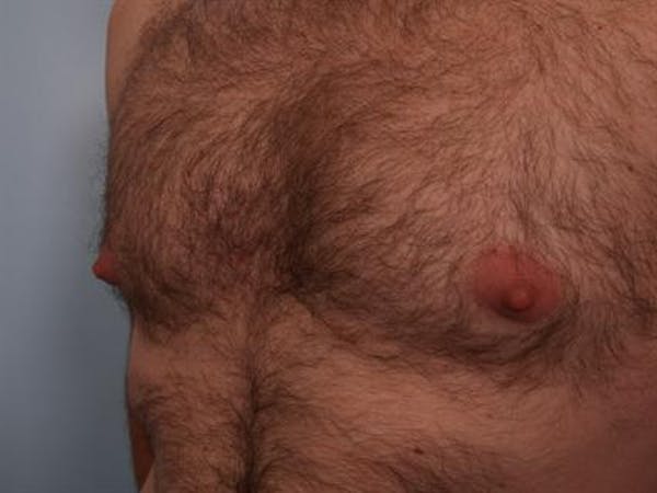 Male Breast/Areola Reduction Gallery - Patient 1311002 - Image 7