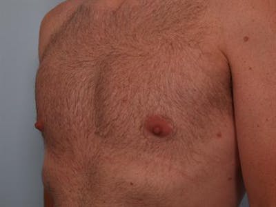 Male Breast/Areola Reduction Gallery - Patient 1311002 - Image 8