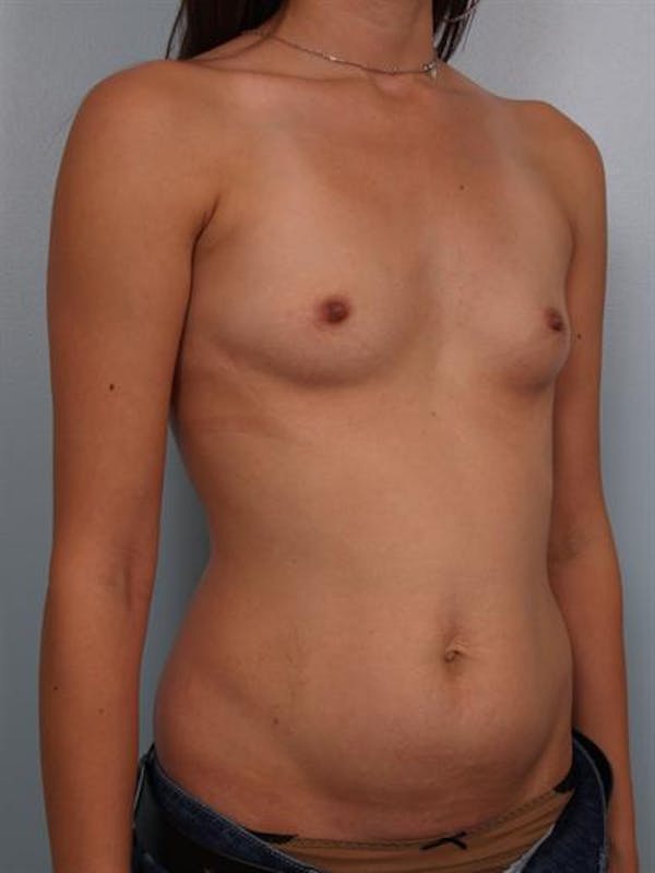 Breast Augmentation Gallery - Patient 1311004 - Image 5