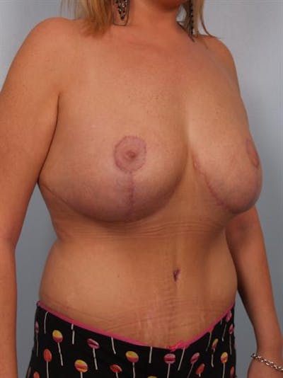 Tummy Tuck Before & After Gallery - Patient 1311005 - Image 4