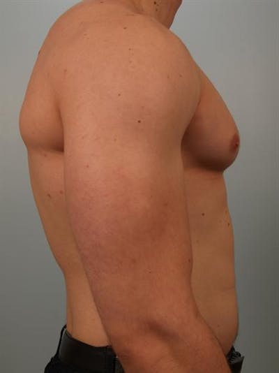 Male Breast/Areola Reduction Before & After Gallery - Patient 1311007 - Image 1