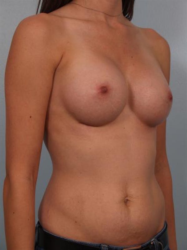 Breast Augmentation Gallery - Patient 1311004 - Image 6
