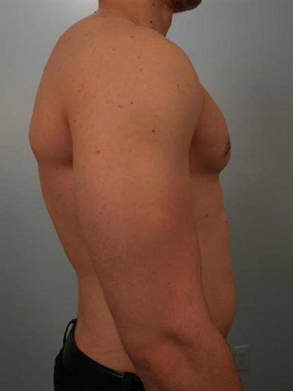 Male Breast/Areola Reduction Before & After Gallery - Patient 1311007 - Image 2