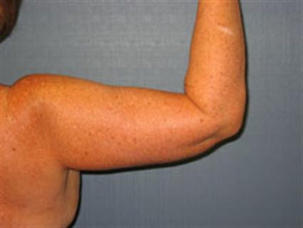 Power Assisted Liposuction Before & After Gallery - Patient 1311008 - Image 2