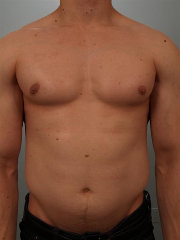Male Breast/Areola Reduction Gallery - Patient 1311007 - Image 4