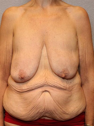 Breast Lift Before & After Gallery - Patient 1311011 - Image 1