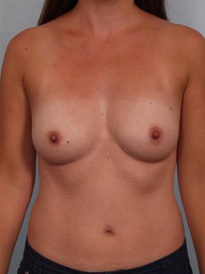 Breast Augmentation Before & After Gallery - Patient 1311012 - Image 1
