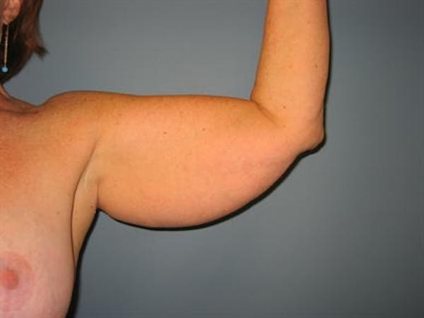 Power Assisted Liposuction Before & After Gallery - Patient 1311008 - Image 5