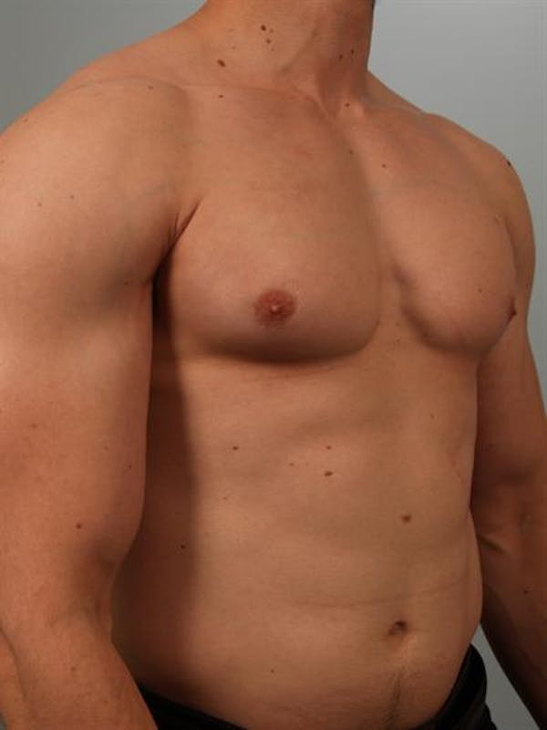 Male Breast/Areola Reduction Gallery - Patient 1311007 - Image 5