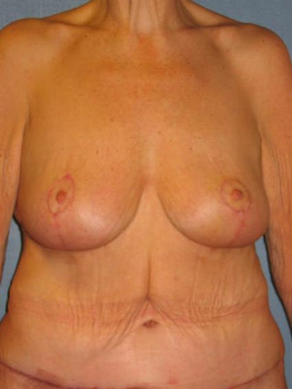 Breast Lift Before & After Gallery - Patient 1311011 - Image 2