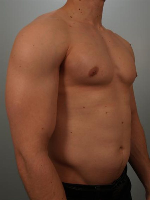 Male Breast/Areola Reduction Before & After Gallery - Patient 1311007 - Image 6
