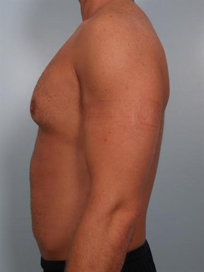 Male Breast/Areola Reduction Gallery - Patient 1311013 - Image 1