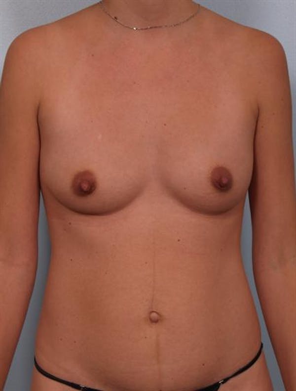 Tummy Tuck Before & After Gallery - Patient 1311010 - Image 5