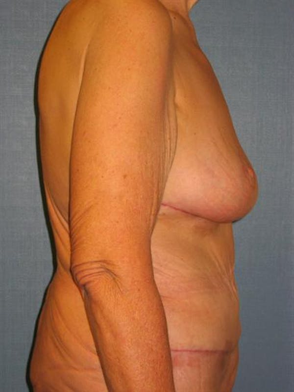 Breast Lift Gallery - Patient 1311011 - Image 4