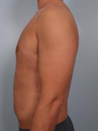Male Breast/Areola Reduction Before & After Gallery - Patient 1311013 - Image 2