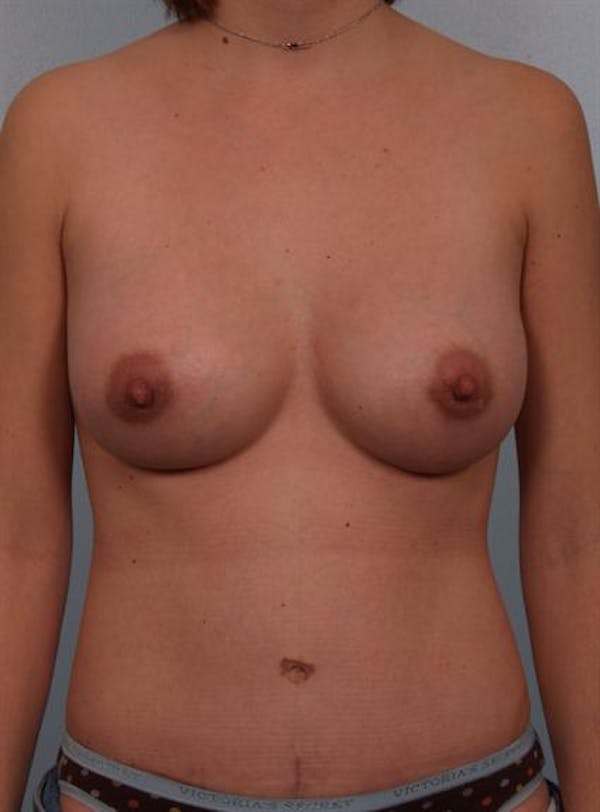 Tummy Tuck Before & After Gallery - Patient 1311010 - Image 6