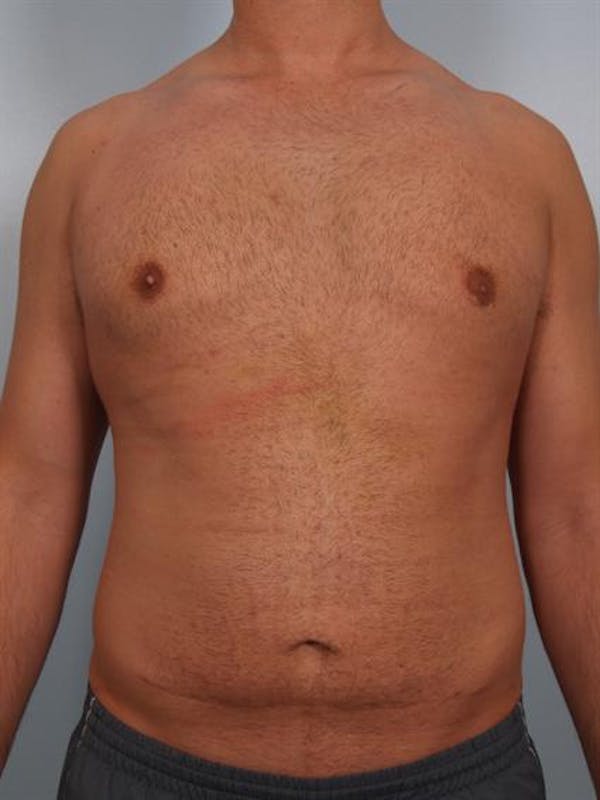 Male Breast/Areola Reduction Before & After Gallery - Patient 1311013 - Image 4