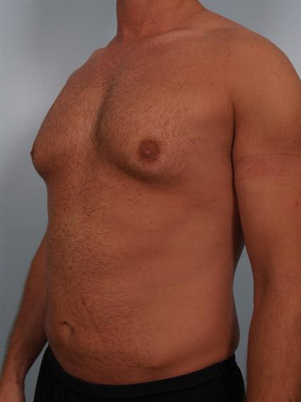 Male Breast/Areola Reduction Before & After Gallery - Patient 1311013 - Image 5