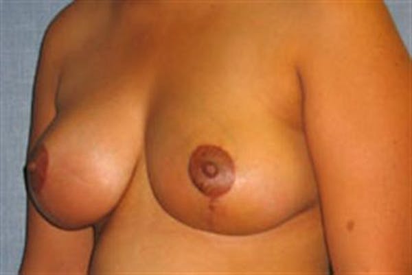 Breast Lift Before & After Gallery - Patient 1311016 - Image 4