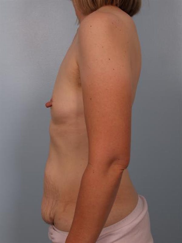 Power Assisted Liposuction Before & After Gallery - Patient 1311014 - Image 5