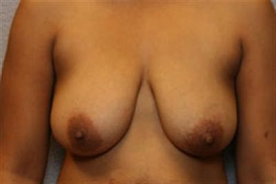 Breast Lift Before & After Gallery - Patient 1311016 - Image 1