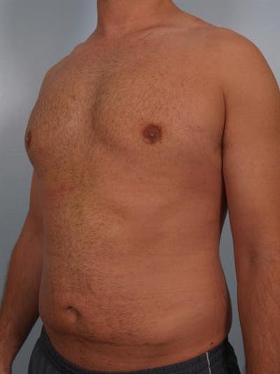 Male Breast/Areola Reduction Before & After Gallery - Patient 1311013 - Image 6