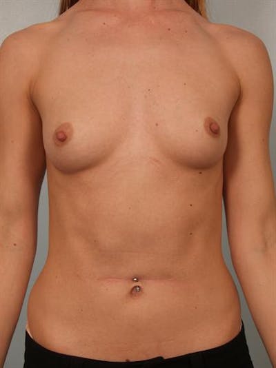 Breast Augmentation Before & After Gallery - Patient 1311017 - Image 1