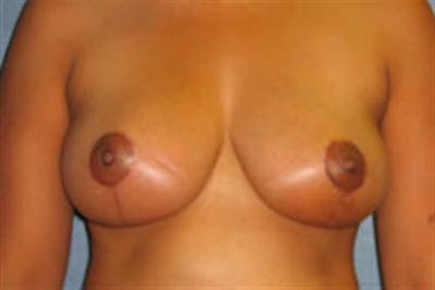 Breast Lift Before & After Gallery - Patient 1311016 - Image 2