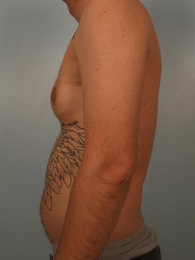 Male Breast/Areola Reduction Before & After Gallery - Patient 1311018 - Image 1