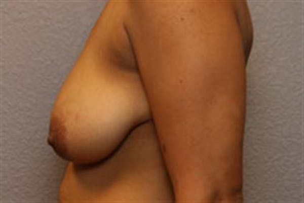 Breast Lift Before & After Gallery - Patient 1311016 - Image 5