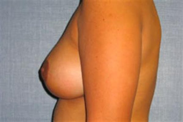 Breast Lift Before & After Gallery - Patient 1311016 - Image 6
