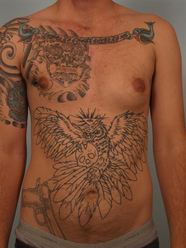 Male Breast/Areola Reduction Gallery - Patient 1311018 - Image 3