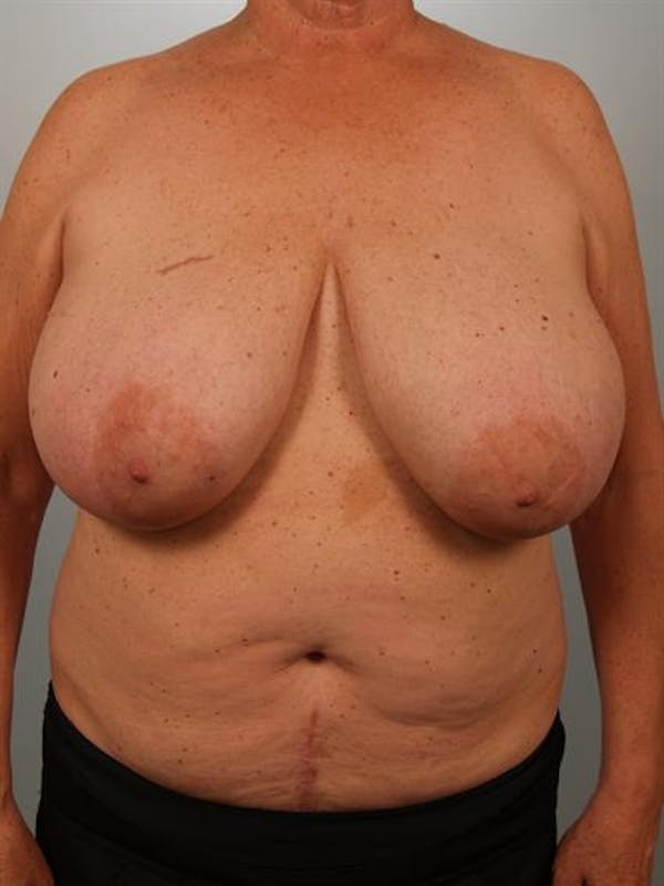 Power Assisted Liposuction Gallery - Patient 1311019 - Image 3