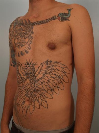 Male Breast/Areola Reduction Before & After Gallery - Patient 1311018 - Image 6