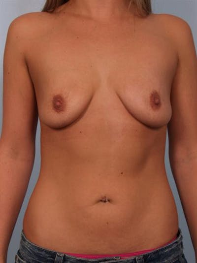 Breast Lift Before & After Gallery - Patient 1311021 - Image 1