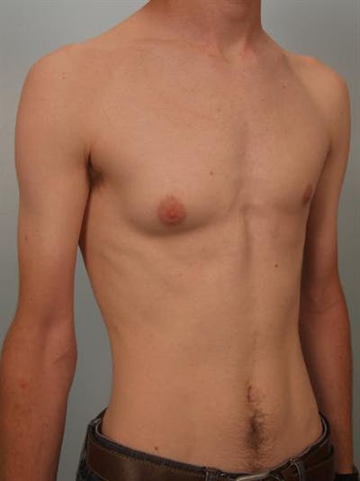 Male Breast/Areola Reduction Gallery - Patient 1311023 - Image 1