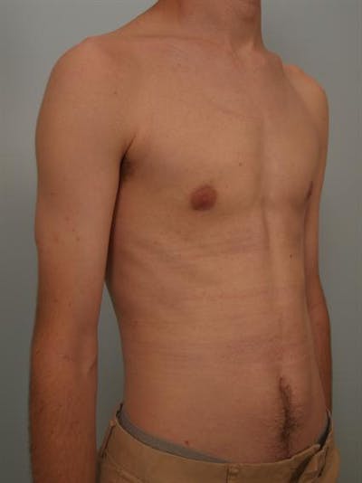 Male Breast/Areola Reduction Before & After Gallery - Patient 1311023 - Image 2