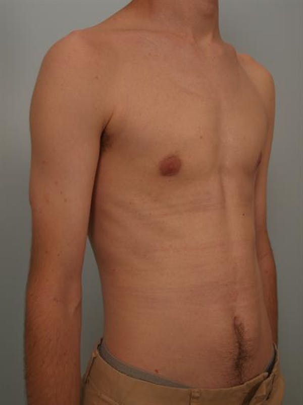 Male Breast/Areola Reduction Before & After Gallery - Patient 1311023 - Image 2