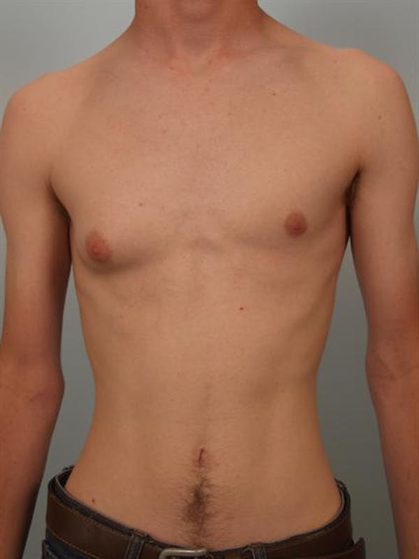 Male Breast/Areola Reduction Before & After Gallery - Patient 1311023 - Image 3