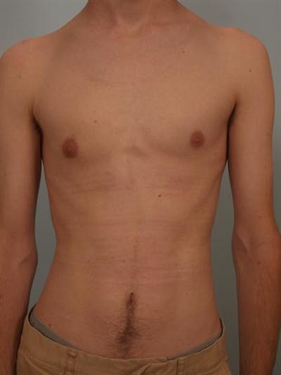 Male Breast/Areola Reduction Before & After Gallery - Patient 1311023 - Image 4