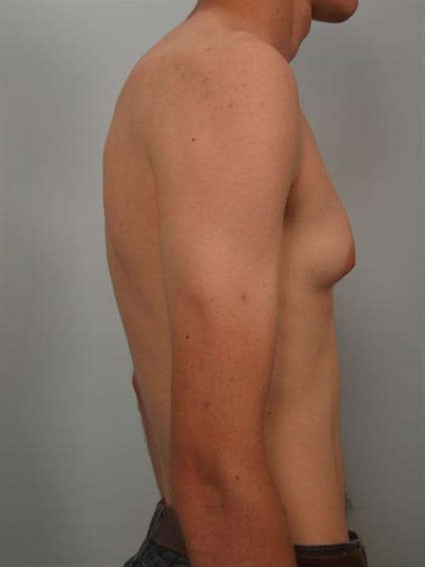 Male Breast/Areola Reduction Before & After Gallery - Patient 1311023 - Image 5