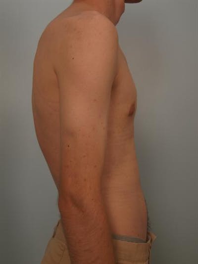 Male Breast/Areola Reduction Before & After Gallery - Patient 1311023 - Image 6