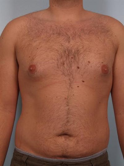 Male Breast/Areola Reduction Before & After Gallery - Patient 1311029 - Image 1