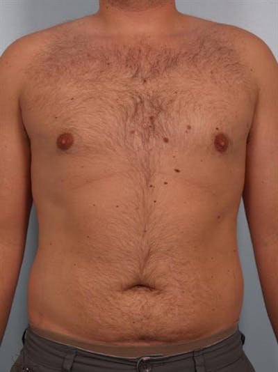 Male Breast/Areola Reduction Before & After Gallery - Patient 1311029 - Image 2