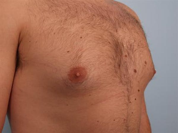 Male Breast/Areola Reduction Before & After Gallery - Patient 1311029 - Image 3