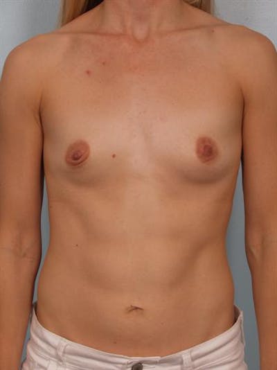 Breast Augmentation Before & After Gallery - Patient 1311031 - Image 1