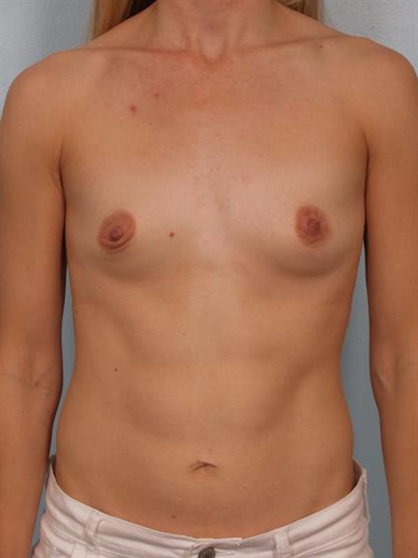 Breast Augmentation Gallery - Patient 1311031 - Image 1