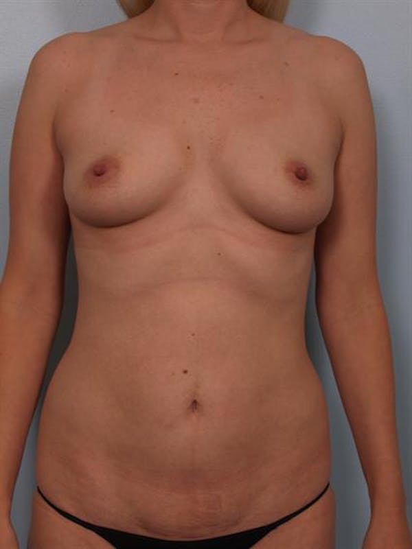 Tummy Tuck Before & After Gallery - Patient 1311028 - Image 3