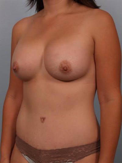 Power Assisted Liposuction Before & After Gallery - Patient 1311030 - Image 4